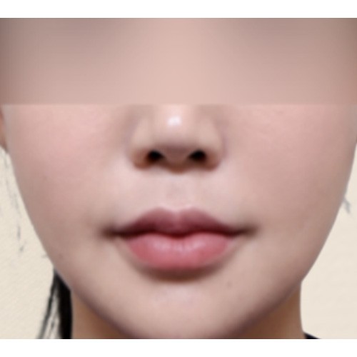 에그볼륨 콜라겐 주사 (옆볼꺼짐) 레디어스