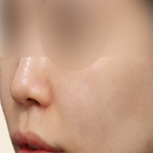 피부 부스터 치료 (본원 리쥬란 + LDM 프로그램)