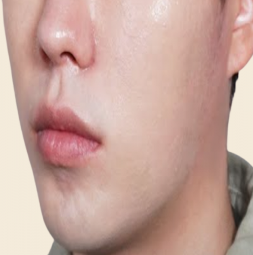 맨즈 프로그램 (티타늄 울쎄라 페이스 카티)