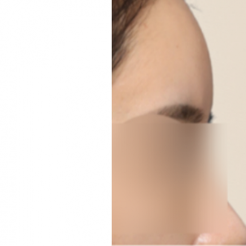 에그볼륨 페이스 바디 필러 (이마)