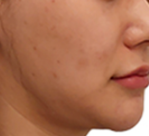 웨딩프로그램 (티타늄 울쎄라 페이스 카티)