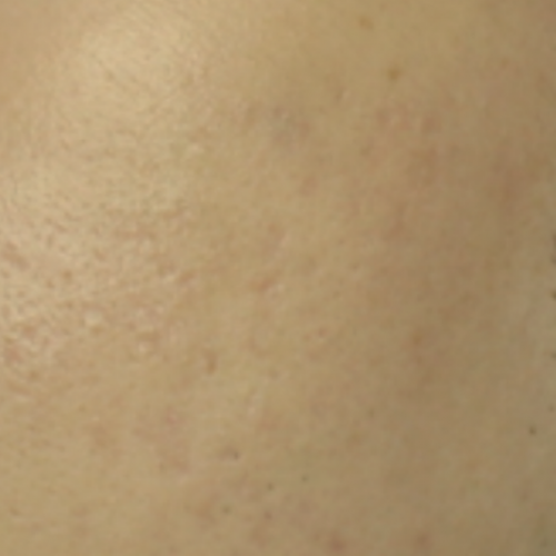 피부 레이저 전문치료 (여드름 치료 골드 PTT) 2회차 후