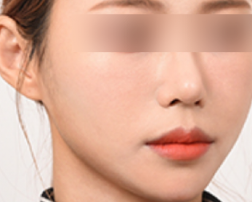 페이스 리프팅