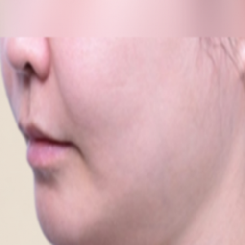 이중턱 카티 지방분해주사