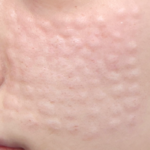 피부 부스터 치료 (리쥬란 + 물광 뉴아티)