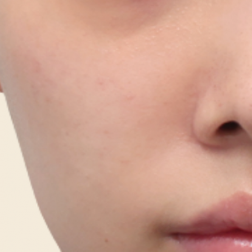 피부 부스터 치료 (리쥬란/물광/LDM)