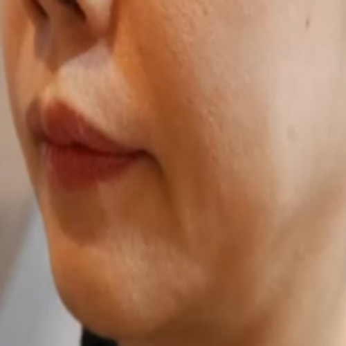 이중턱 카티 지방분해주사