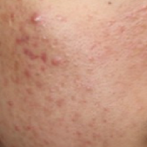 피부 레이저 전문치료 (골드 PTT 3회후)