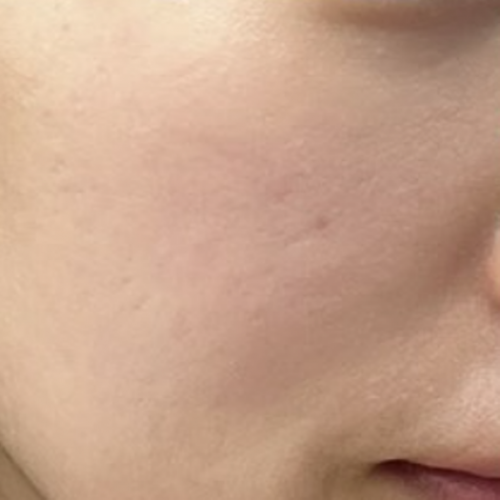 웨딩프로그램 (리쥬란 + 리바이브)