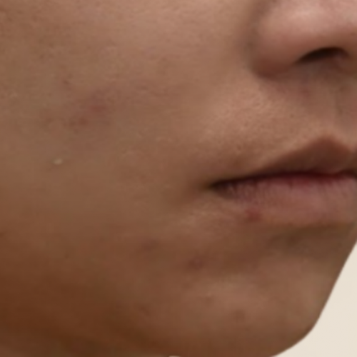 피부 레이저 전문치료 (골드PTT) 여드름 3회차
