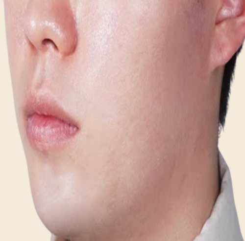 맨즈 프로그램 (티타늄 울쎄라 페이스 카티)