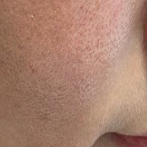 웨딩 프로그램 (리쥬란 물광  LDM 복합프로그램 3회)