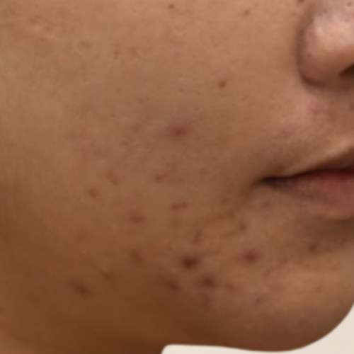 피부 레이저 전문치료 (골드PTT) 여드름 3회차