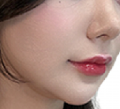 웨딩프로그램 (티타늄 울쎄라 페이스 카티)