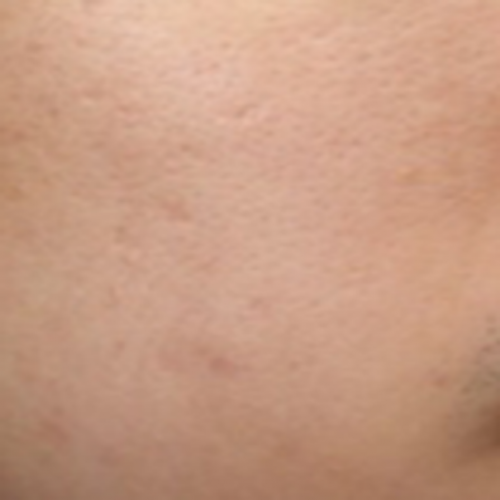 피부 레이저 전문치료 (골드 PTT 3회후)