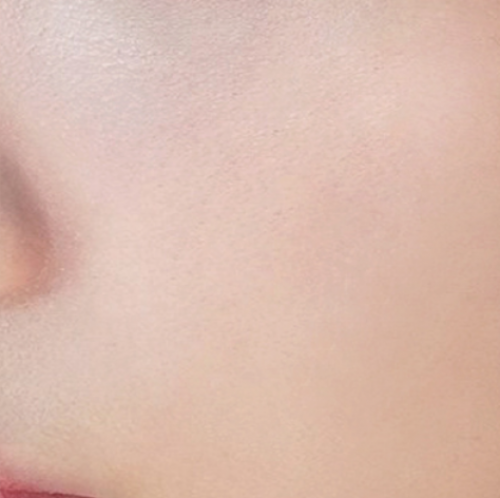 피부 부스터 치료 (리쥬란 + 물광 뉴아티)