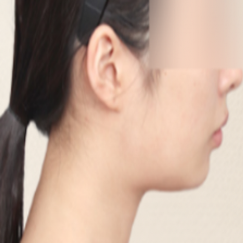페이스 리프팅