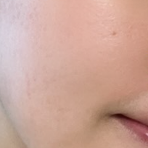 웨딩프로그램 (리쥬란 + 리바이브)