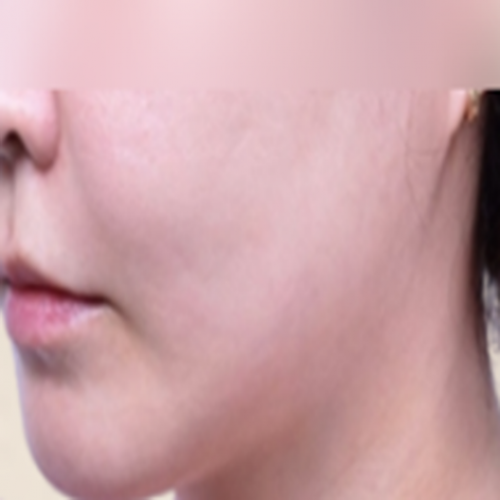 이중턱 카티 지방분해주사