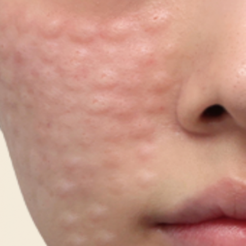 피부 부스터 치료 (리쥬란/물광/LDM)